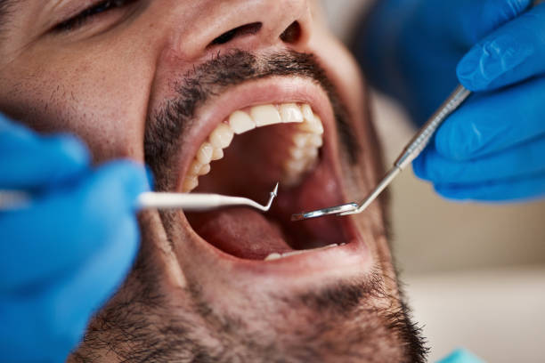 Best Emergency Dental Care for Abscessed Tooth in Lake Sarasota, FL