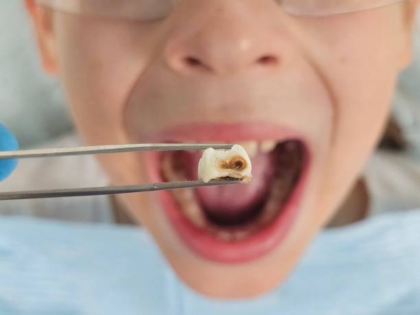 Best Mobile Emergency Dentist in Lake Sarasota, FL