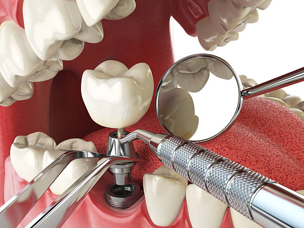 Best Emergency Root Canal Treatment in Lake Sarasota, FL